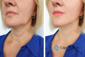 Double chin before and after Hi-Fu treatment 4 Book your double chin treatment Amersham today! We are here to help!