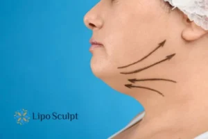 Double chin before and after Hi-Fu treatment 3 Boost your confidence with a Double chin treatment Amersham