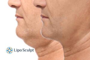 Double chin before and after Hi-Fu treatment 2 Double chin treatment Amersham from Lipo Sculpt - feel more confident today!