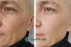 How to Fight Aging Symptoms 3 Fight Aging Symptoms Amersham With HIFU and Morpheus8 Today!
