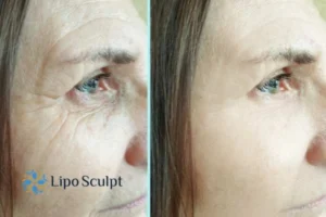 How to Fight Aging Symptoms 2 Do you want to Fight Aging Symptoms Amersham? Contact Lipo Sculpt today!