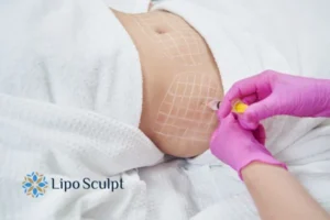 Are The Results From Aqualyx Permanent? 1 Do you want to know how long Aqualyx Amersham results last?