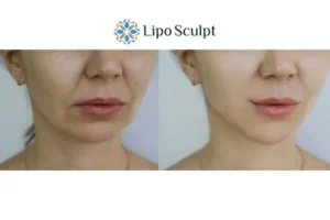 Explaining Total Skin Tightening Treatment And What It Can Do For You 2 Do you want to boost your self confidence? Give Morpheus8 Amersham a try today!
