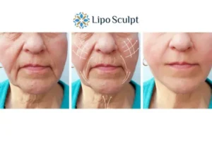 Explaining Total Skin Tightening Treatment And What It Can Do For You 3 Boost your confidence with Morpheus8 Amersham call our team today!