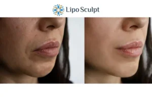 Explaining Total Skin Tightening Treatment And What It Can Do For You 4 Morpheus8 Amersham the best results - call our team today!