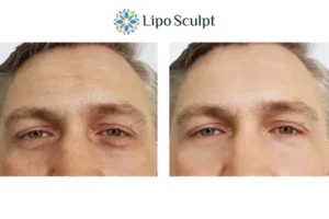 Explaining Total Skin Tightening Treatment And What It Can Do For You 6 Morpheus8 Amersham book in today to find out more!