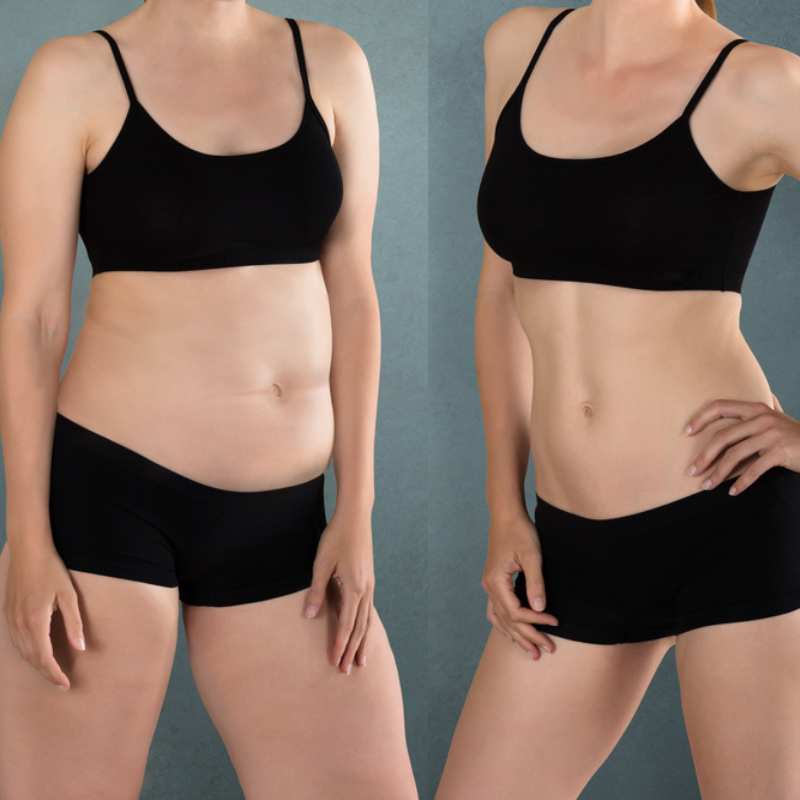 Does Fat Freezing at Home Work? DIY Devices vs Professional Cryolipolysis 2 before and after Cryolipolysis Amersham