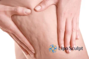 CoolSculpting for Legs: The Innovative Approach to Redefining Your Legs 5 Start your journey today book your coolsculpting treatment Amersham online today!