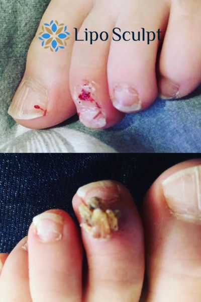 Wart removal customer results from Lipo Sculpt Amersham