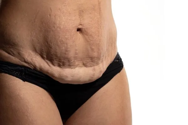 Lost the Weight but Not the Loose Skin? 1 image of womans stomach after weight loss showing loose skin Amersham